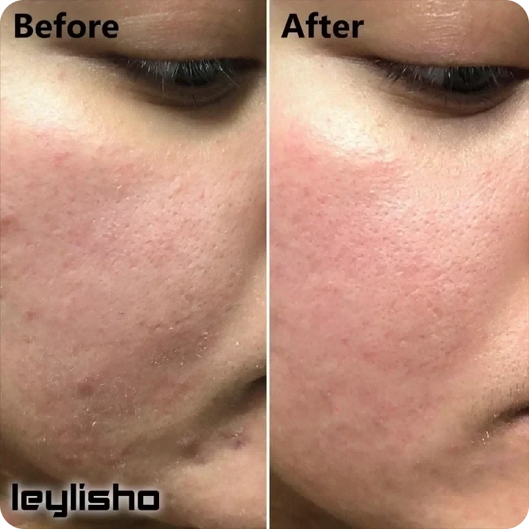 خاصیت سرم لاکتیک اسید اوردینری